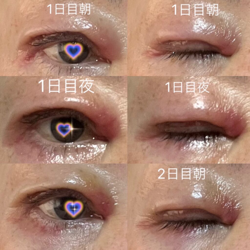眼瞼下垂手術から1日目から2日目までのダウンタイム経過写真