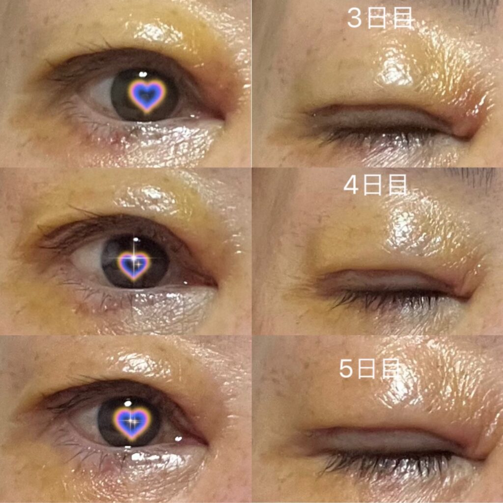 眼瞼下垂手術から3日目から5日目までの腫れと内出血の経過写真