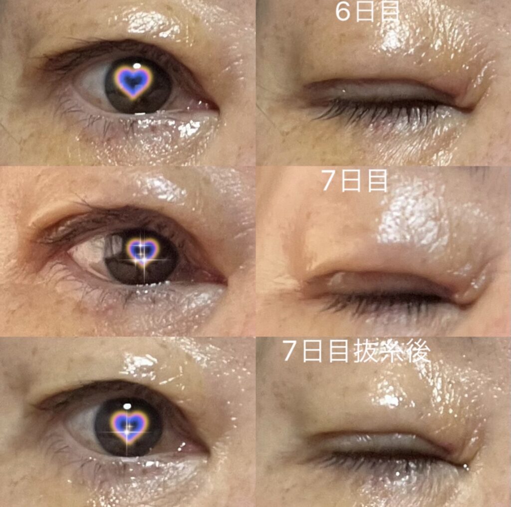 眼瞼下垂手術6日目・7日目と抜糸後のダウンタイム経過写真